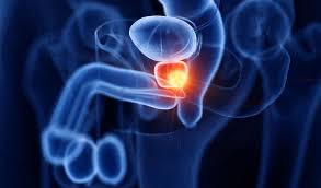 Illustration of prostate inflammation and urinary anatomy